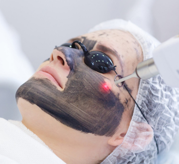 Laser Carbon Facial