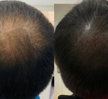 Scalp Hairline micropigmentation