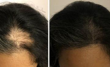 Scalp Hairline micropigmentation