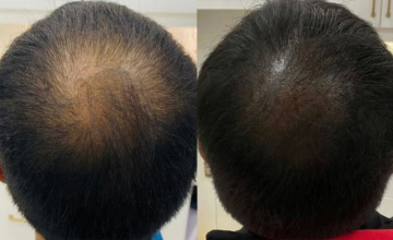 Scalp Hairline micropigmentation