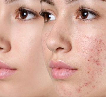 Acne Treatment