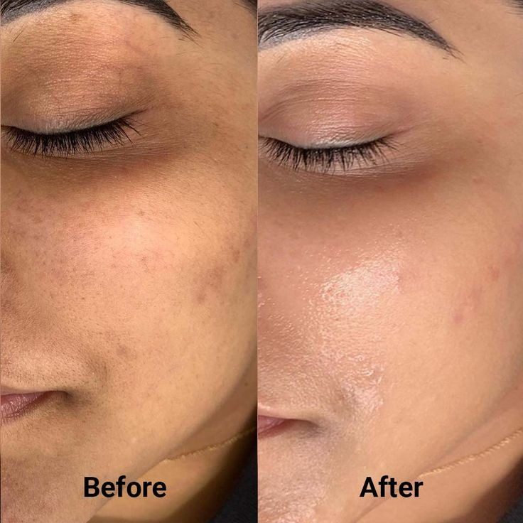 Skin treatment before and after — pigmentation and acne reduction